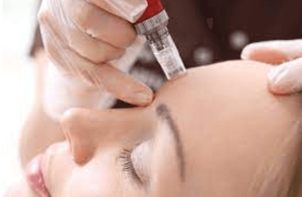 MTS (Microneedling)